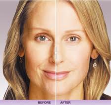 nasoloabial smile line fillers botox nyc